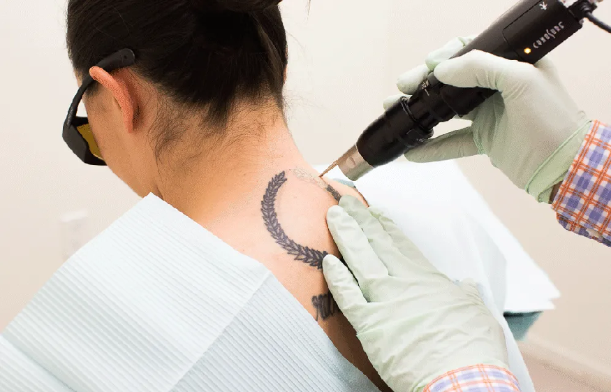 Heal Faster After Getting a Tattoo Removal