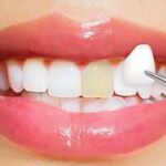 Cosmetic Dental Solutions For Chipped Or Broken Teeth