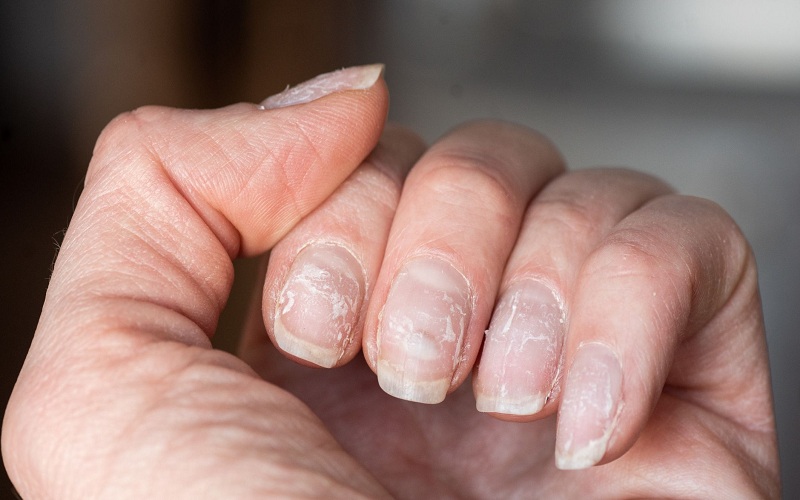 Nail Health