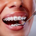 The Impact Of Orthodontic Treatment On Chewing Function