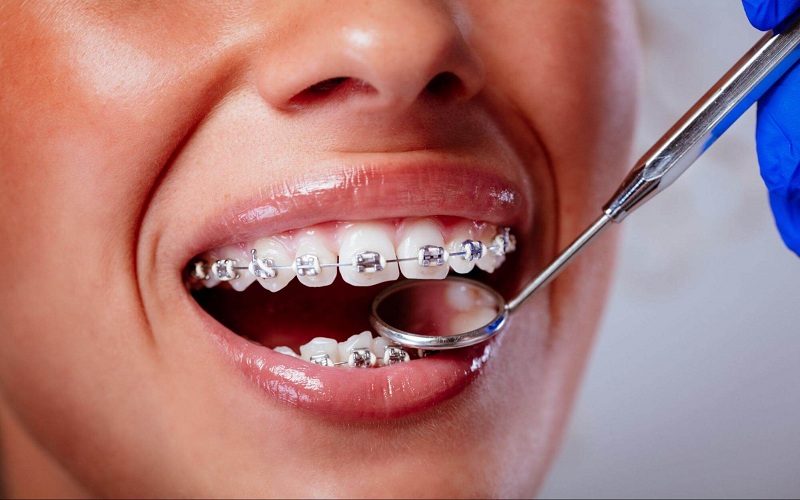 Orthodontic Treatment